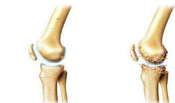 Symptome von Knie -Basis -Anziehungskraft