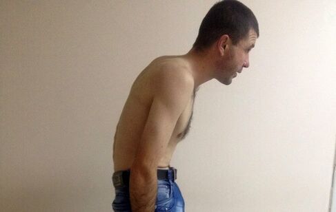 Spondylitis ankylosans kann im Laufe der Jahre Schmerzen im unteren Rückenbereich verursachen